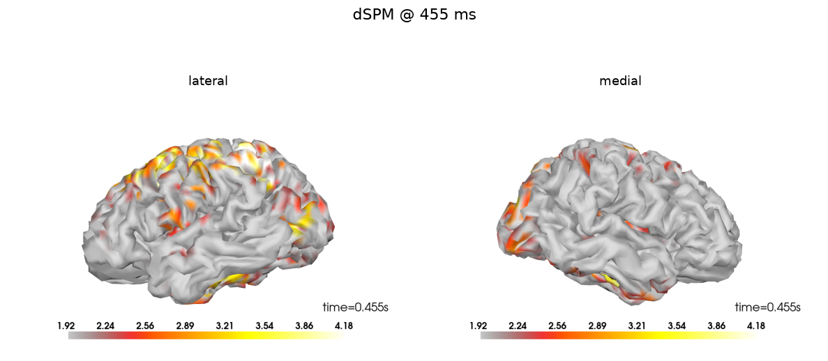 dSPM estimate at the peak, left hemisphere, lateral and medial views.