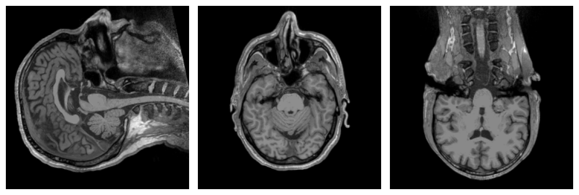 The subject's T1, sagittal, coronal and axial slices.