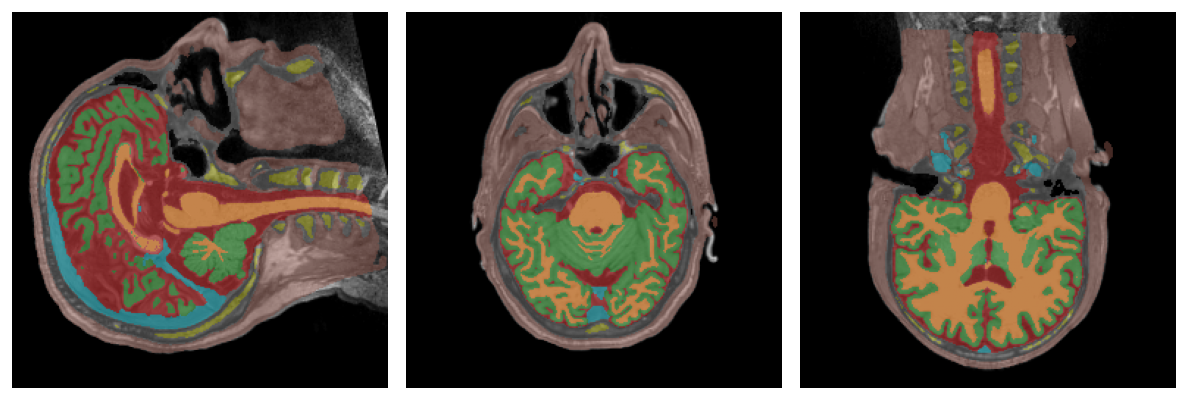 Tissue segmentation overlaid on the T1. Each colour is a conductivity class of the FEM model.