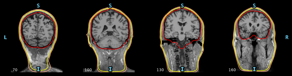 The three BEM surfaces (inner skull in red, outer skull and skin in yellow) over coronal T1 slices.