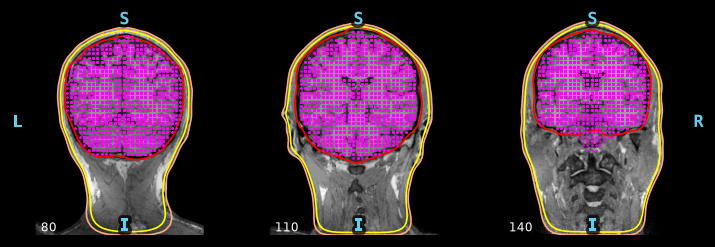 Source grid (magenta) filling the brain volume.