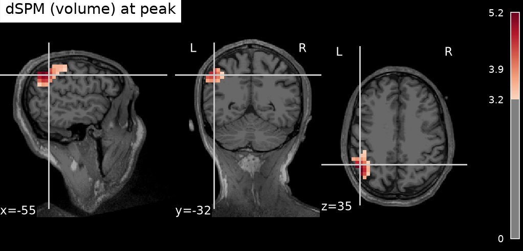 Volumetric dSPM estimate at the peak, overlaid on the T1 (orthogonal view, crosshair on the maximum).
